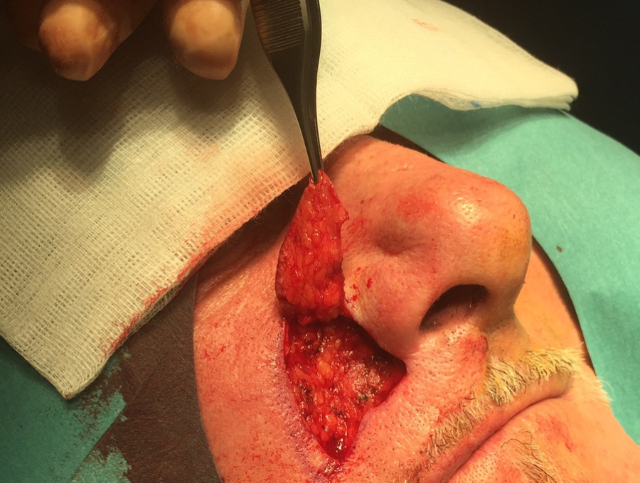 Chirurgie des sinus - Centre de chirurgie du visage ORL et